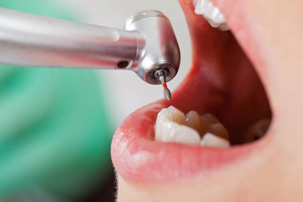 Best Emergency Tooth Extraction in Pinardville, NH